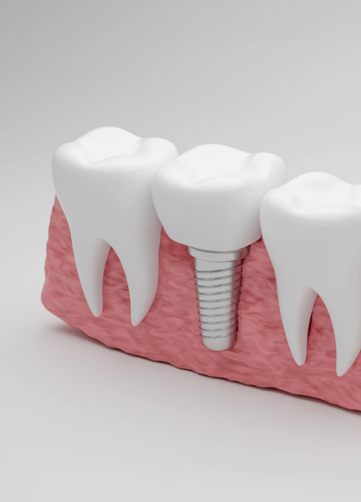 JD ICON IMPLANTAS SU ĮSRIEGIMU – 499 €
