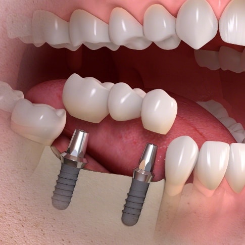 Implantų garantija